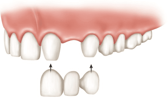 Dental Bridge Diagram