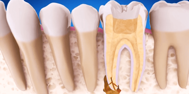 Root Canal Diagram