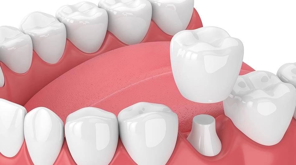 Dental Crown Diagram