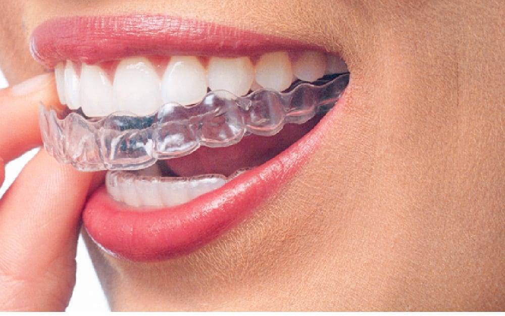 Affordable Braces near me Brooklyn