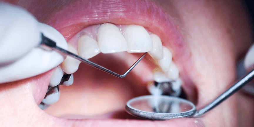 Dental Cleaning