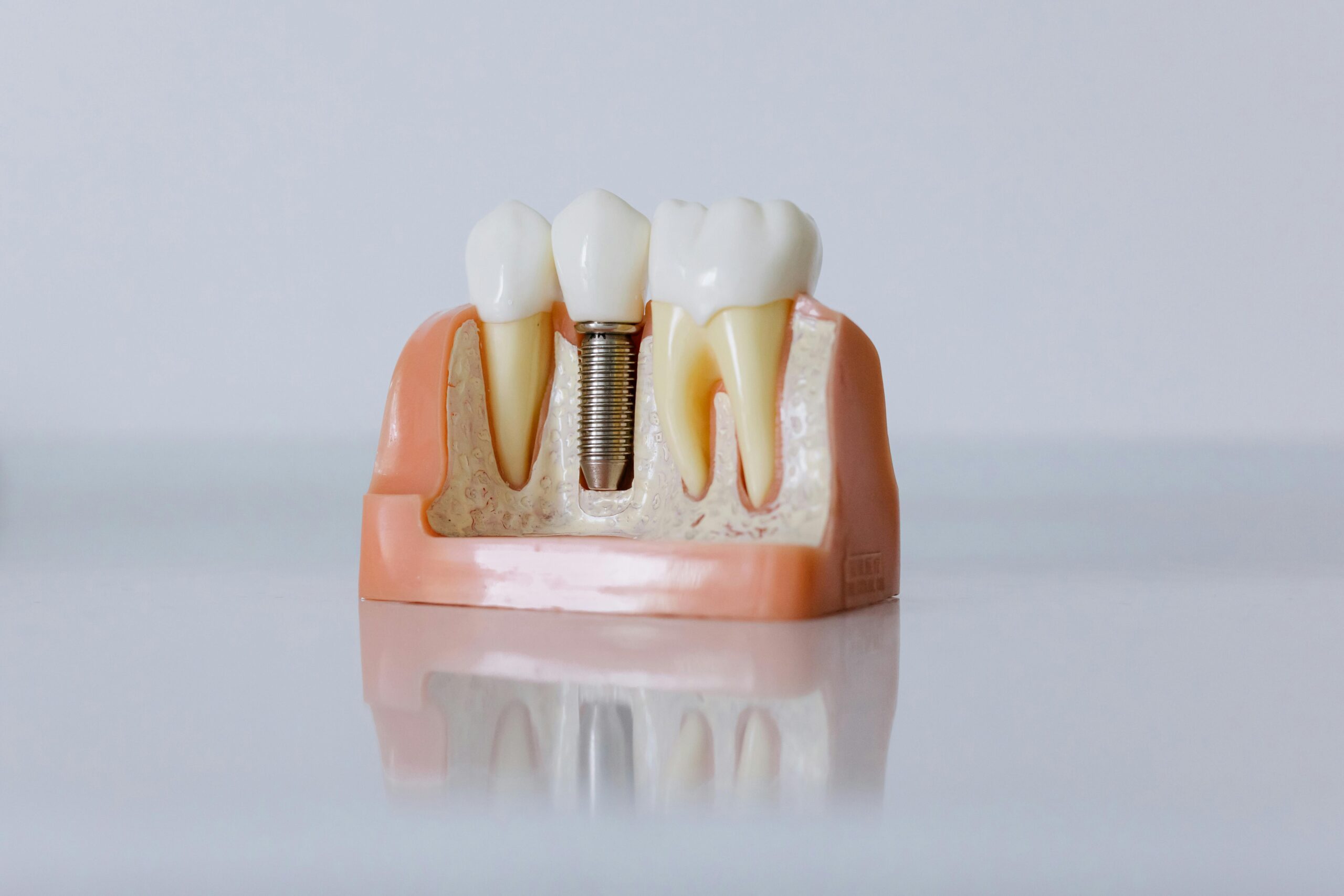 Dental Implants Dental Implants